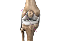 ACL Reconstruction (Hamstring Tendon)