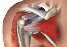 biceps tenodesis slap shoulder tenotomy tears arthroscopy without repair tendon