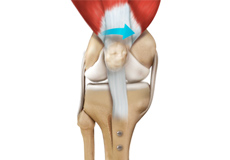 Patellofemoral Stabilisation 