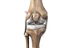 Anterior Cruciate Ligament (ACL) Tears