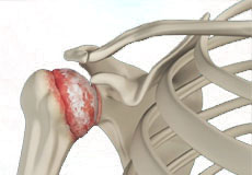 Shoulder Arthritis