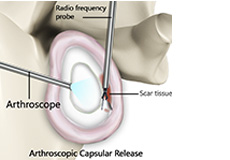 Arthroscopic Capsular Release