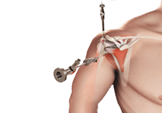 Arthroscopic Rotator Cuff Repair