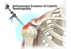 Calcific Tendinopathy