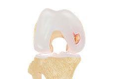 Chondral (articular Cartilage) Defects