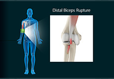 Distal Biceps Rupture