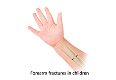 Forearm Fractures in Children