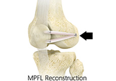 Medial Patellofemoral Ligament Reconstruction