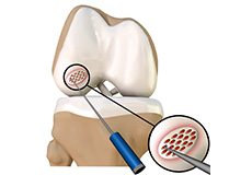 Microfracture