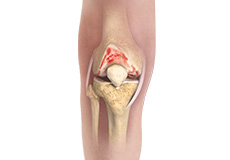 Osteoarthritis Management