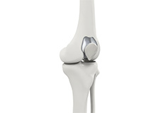 Patellofemoral Knee Replacement