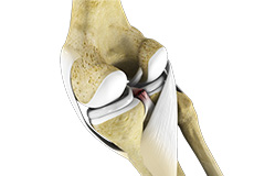 Posterior Cruciate Ligament Injuries