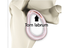 Shoulder Joint Tear (Glenoid Labrum Tear)