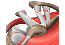 Shoulder Separation or AC Joint Dislocation