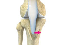 Tibial Tubercle Transfer