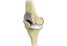 Knee Replacement